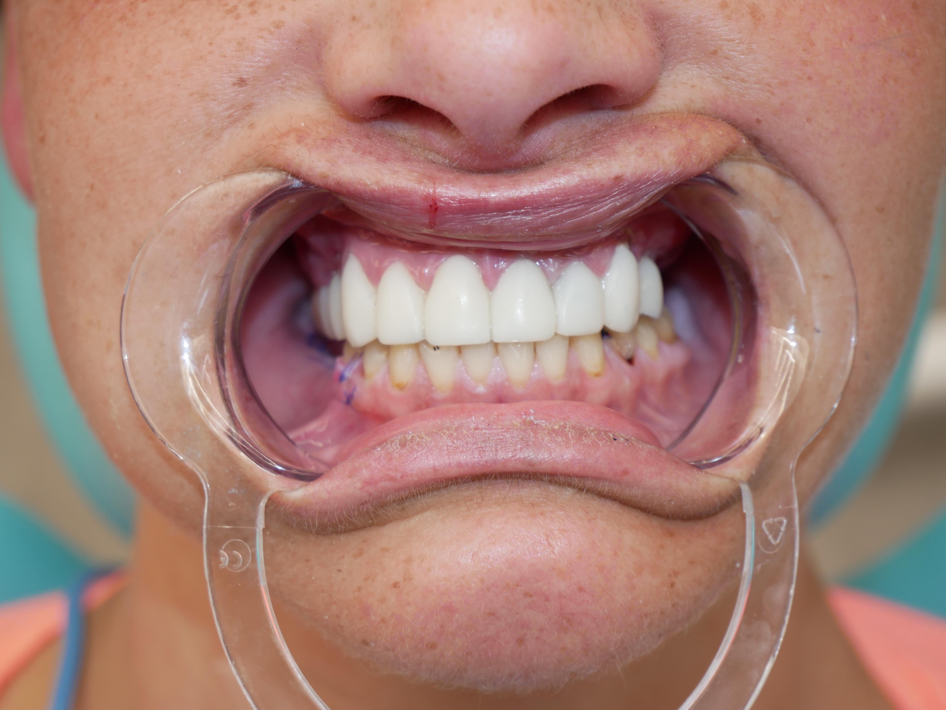 Dental Veneers