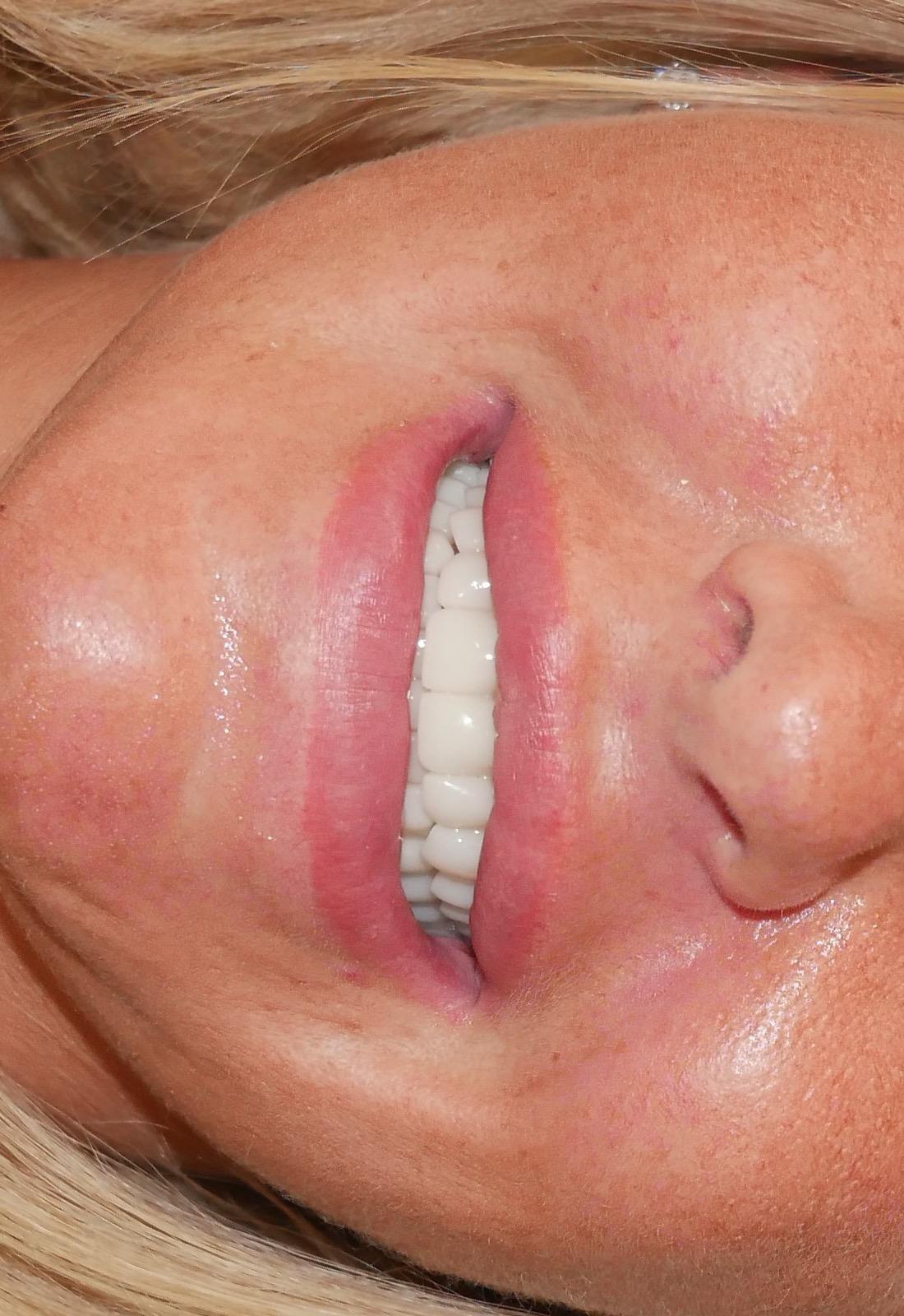 Veneers vs Crowns: Which One Do You Actually Need?